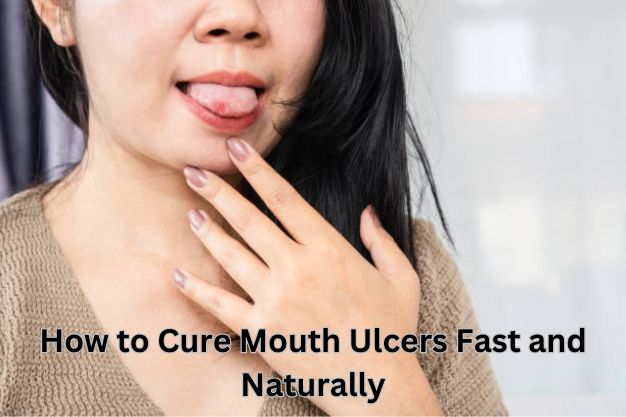 Mouth Ulcers